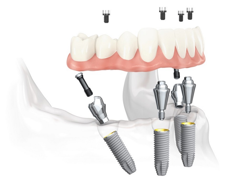 Протезирование All on 4 в картинках all on 4 картинки